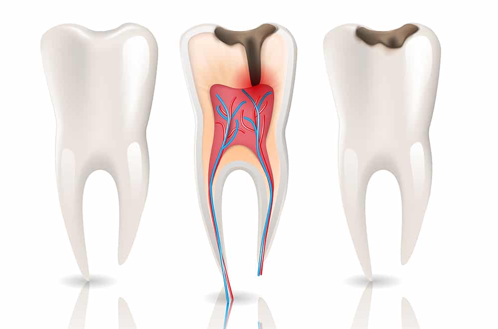 tipos de cavidades dentales segun black
